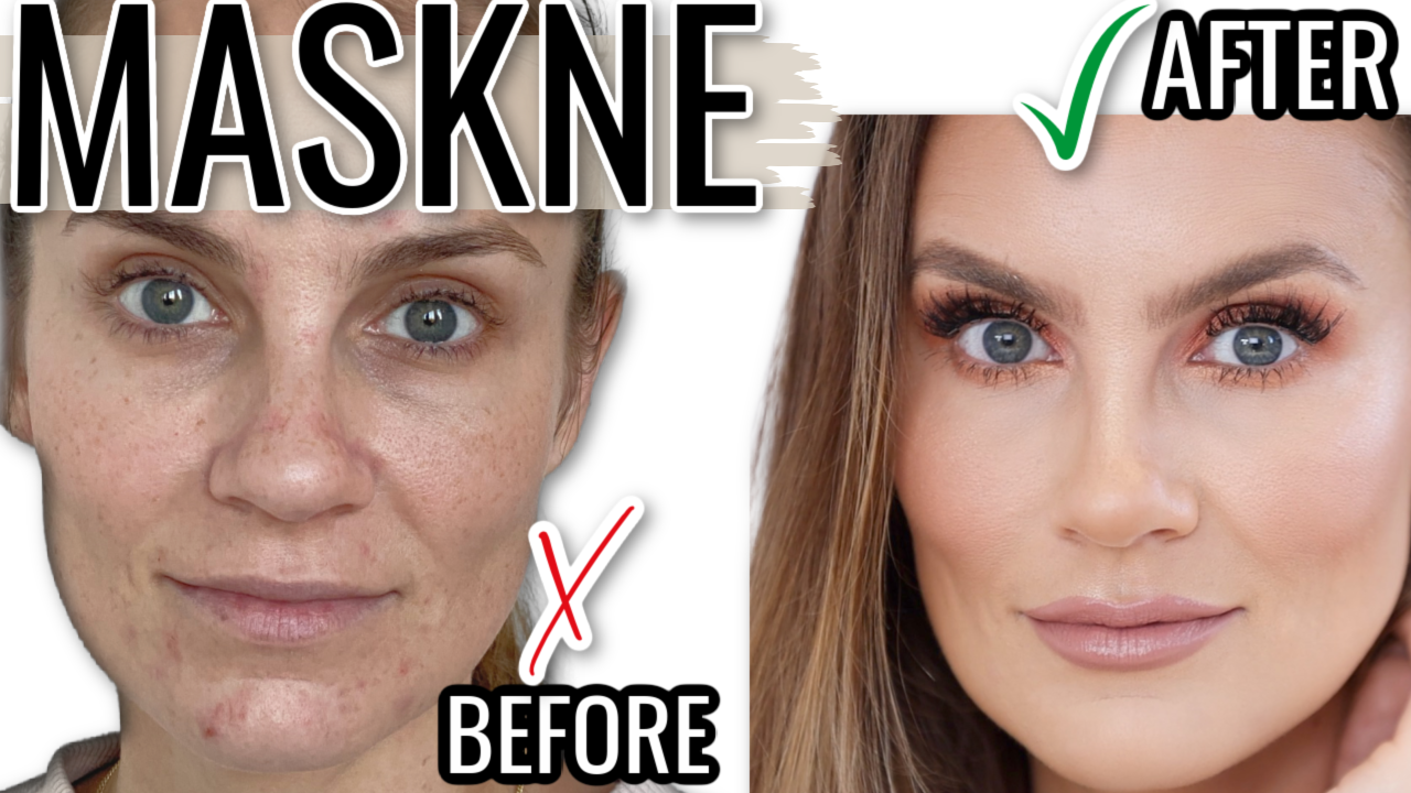 How to GET RID of Maskne: Must-Haves for Mask Acne